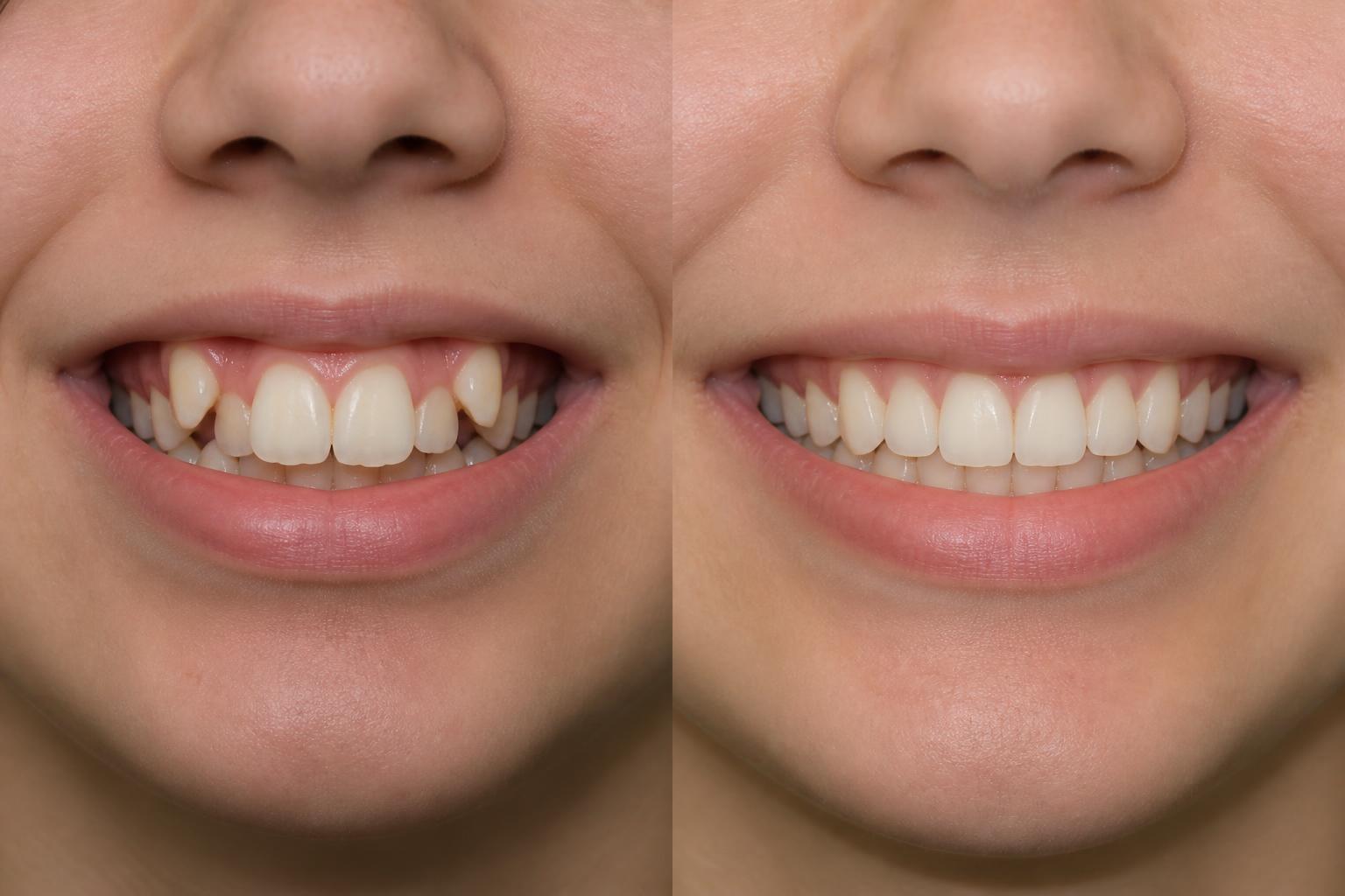 Before and after — Sophie, 15