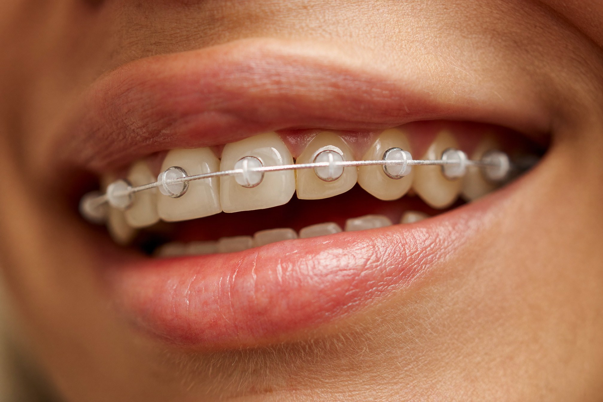 Close-up of tooth-coloured ceramic clear braces