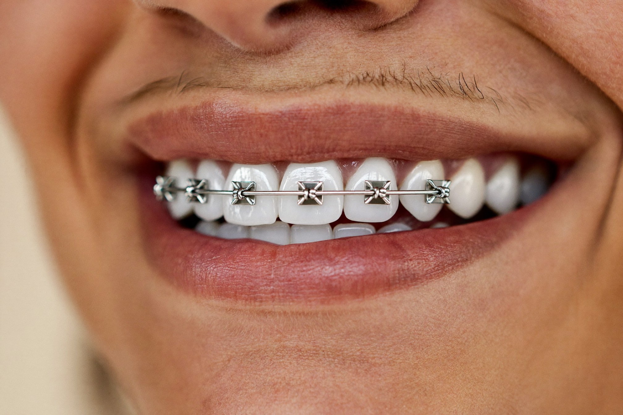 Close-up of discreet modern fixed metal braces